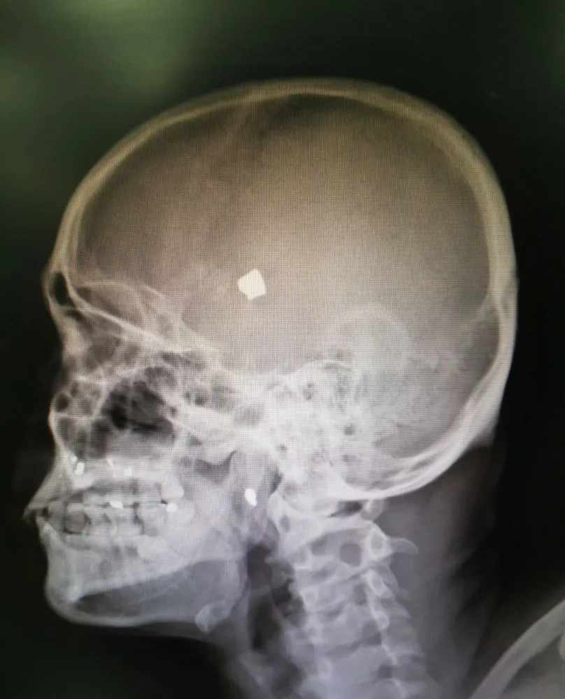 X-ray of a bullet inside the head of a gunshot victim (Credits: DrCHAMPGO/Shutterstock)