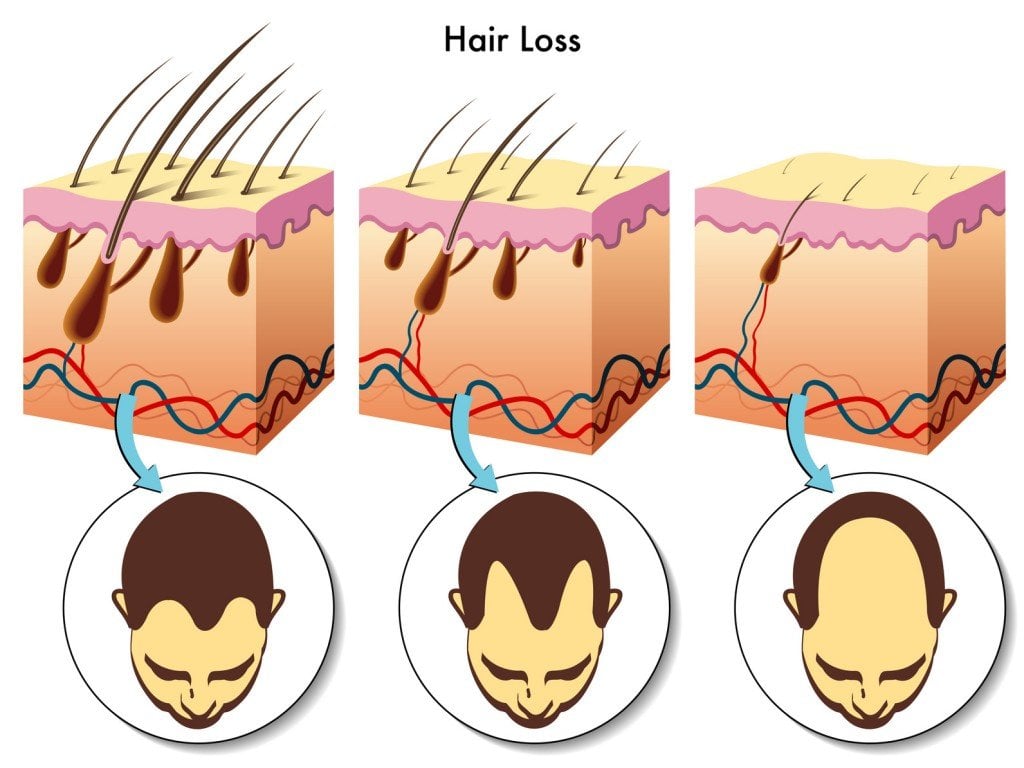 Baldness Over Time (Photo Credit: rob3000 / Fotolia)