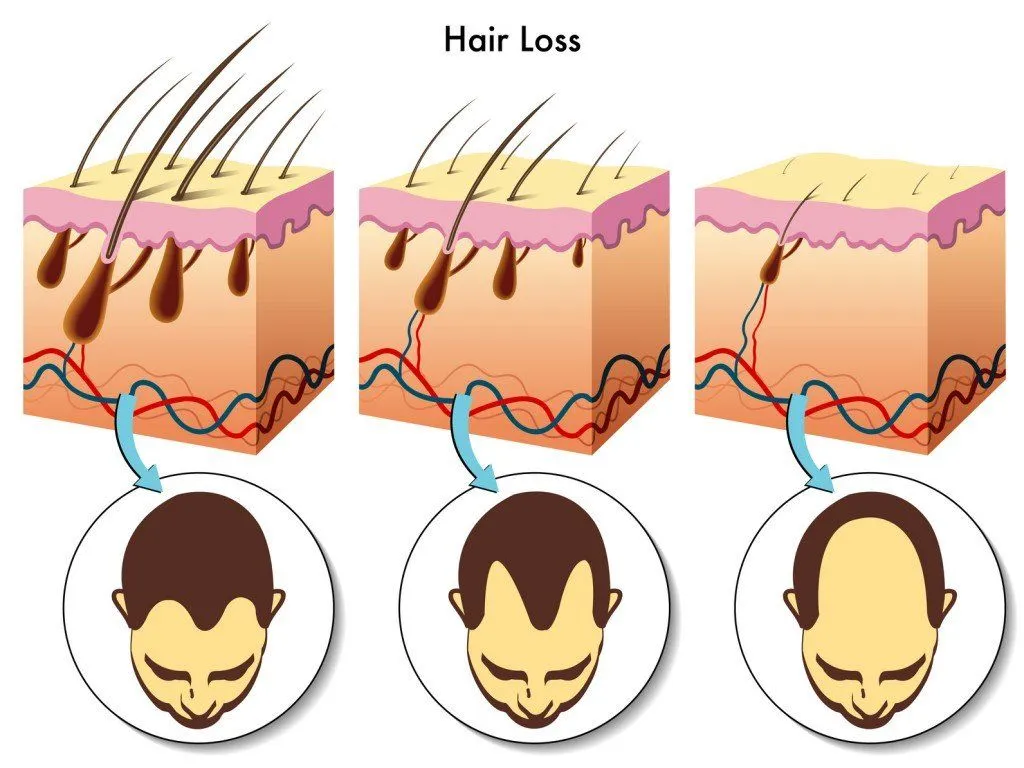 Baldness Over Time (Photo Credit: rob3000 / Fotolia)