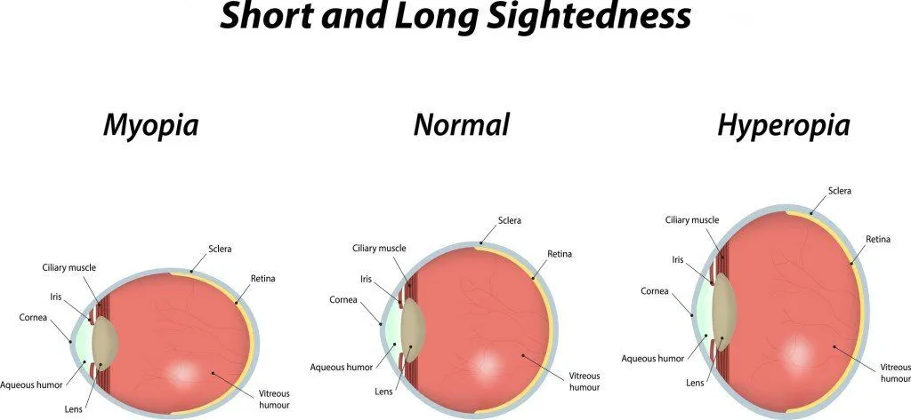 Hyperopia and Myopia (Photo Credit: joshya / Fotolia)