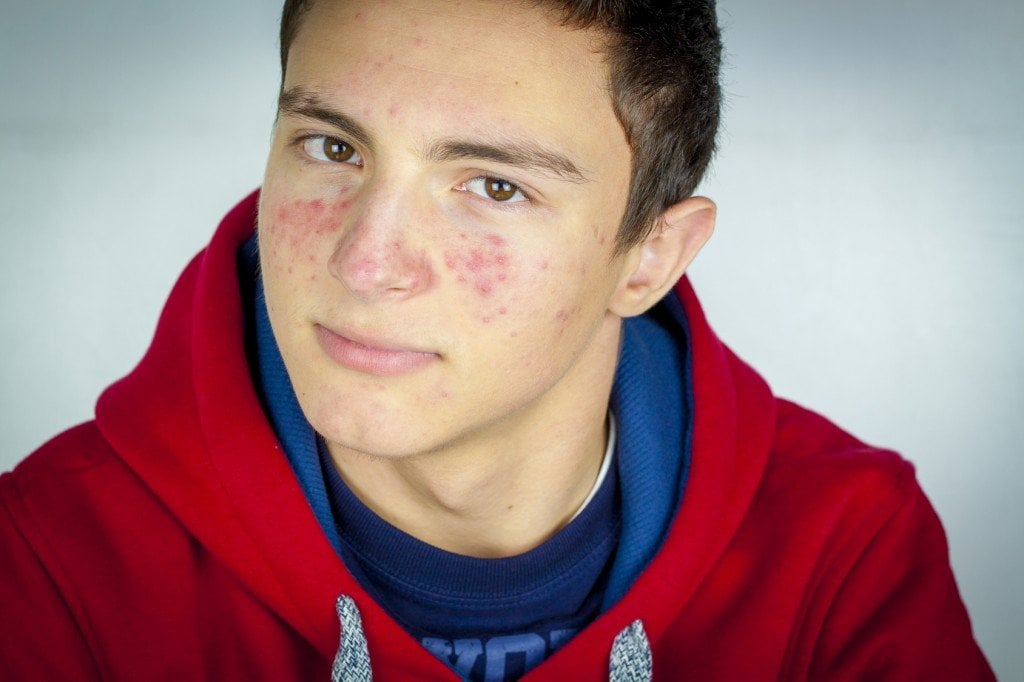 Boy with Acne (Photo Credit: hriana / Fotolia)