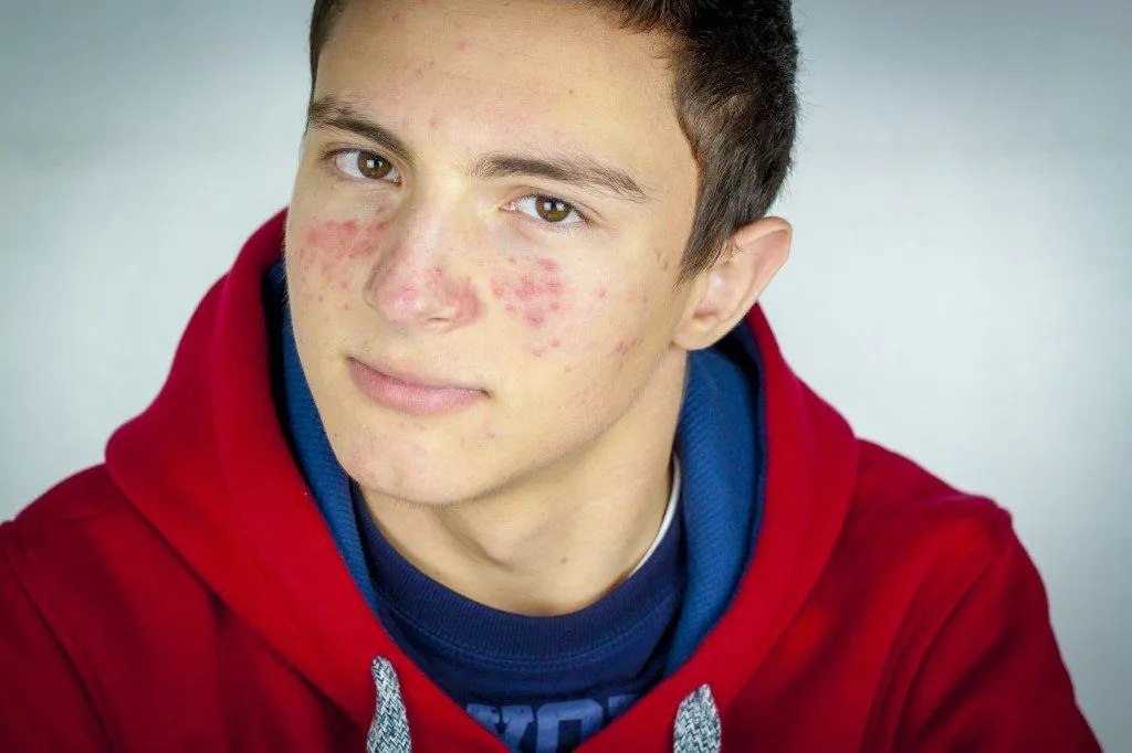 Boy with Acne (Photo Credit: hriana / Fotolia)