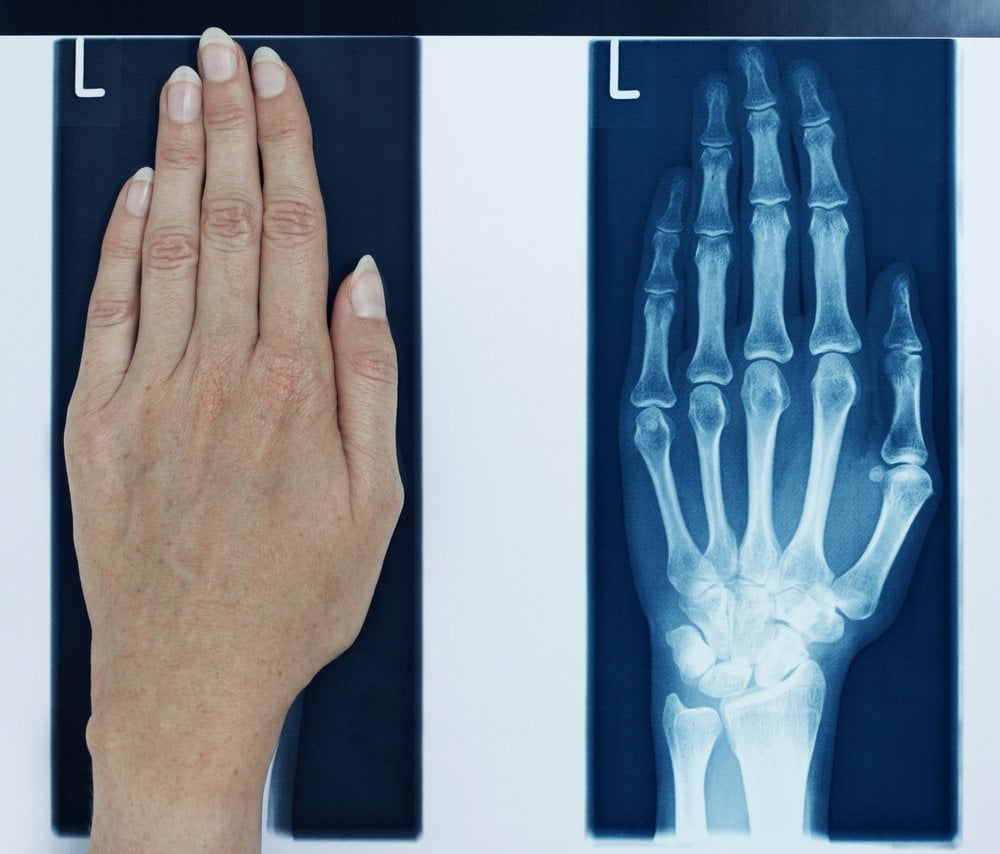 x-ray left hand