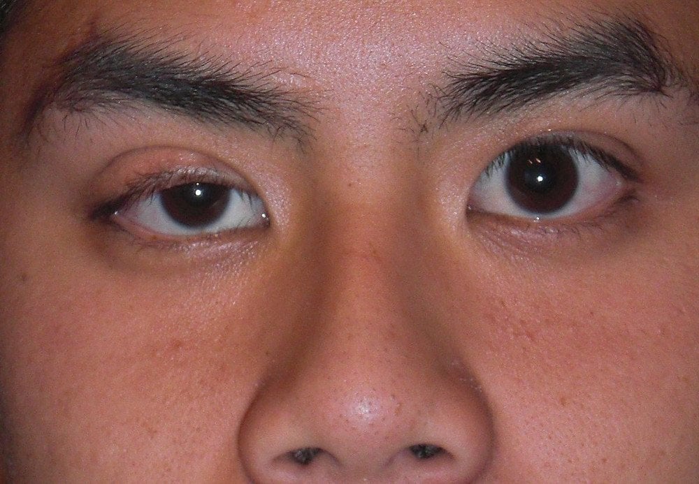 Mild right eyelid ptosis