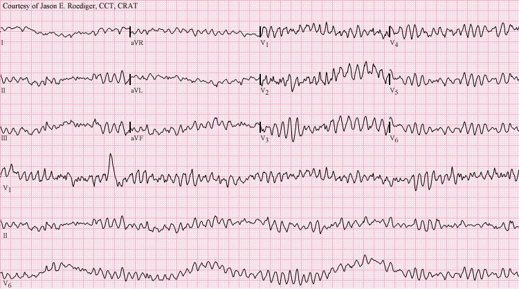 Ventricular fibrillation