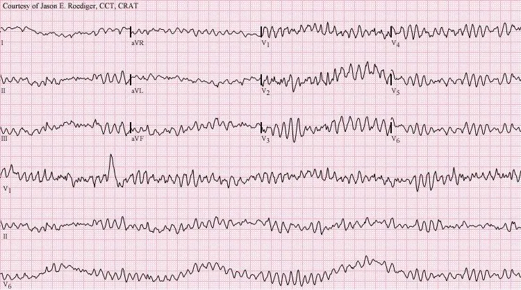 Ventricular fibrillation