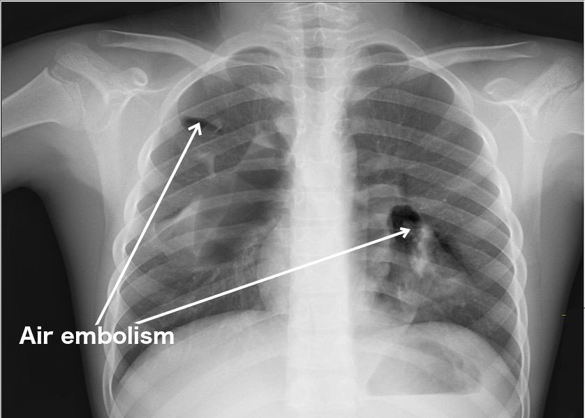 Air embolism in human body x ray sonography