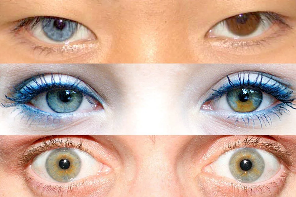 What Is Heterochromia? Why Does It Occur?