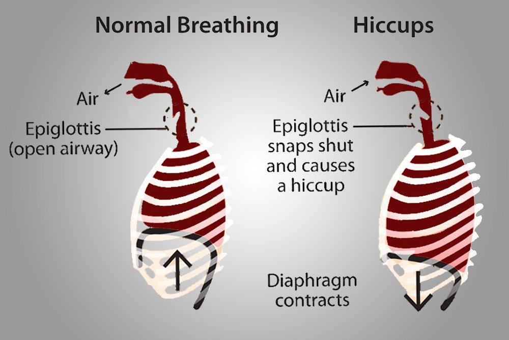 hiccups
