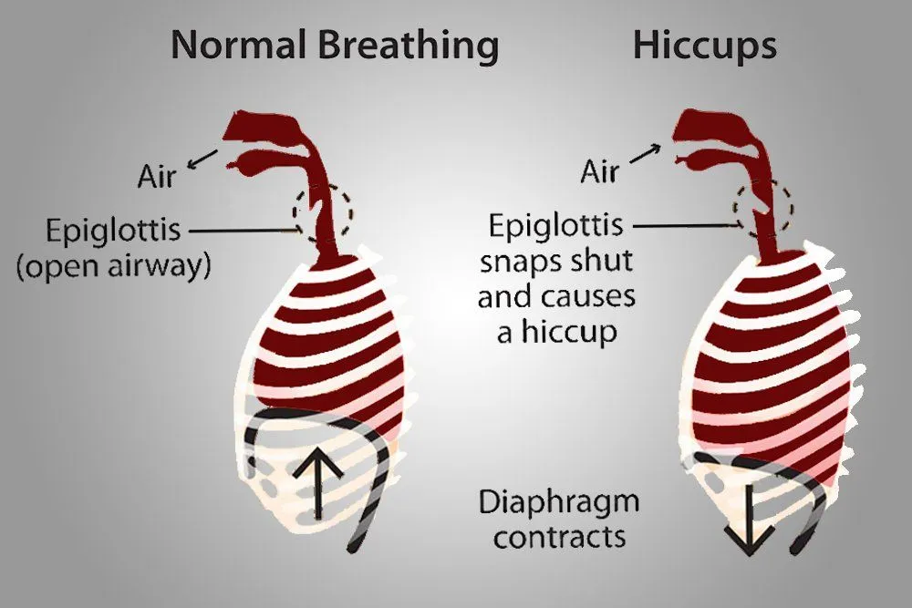 hiccups