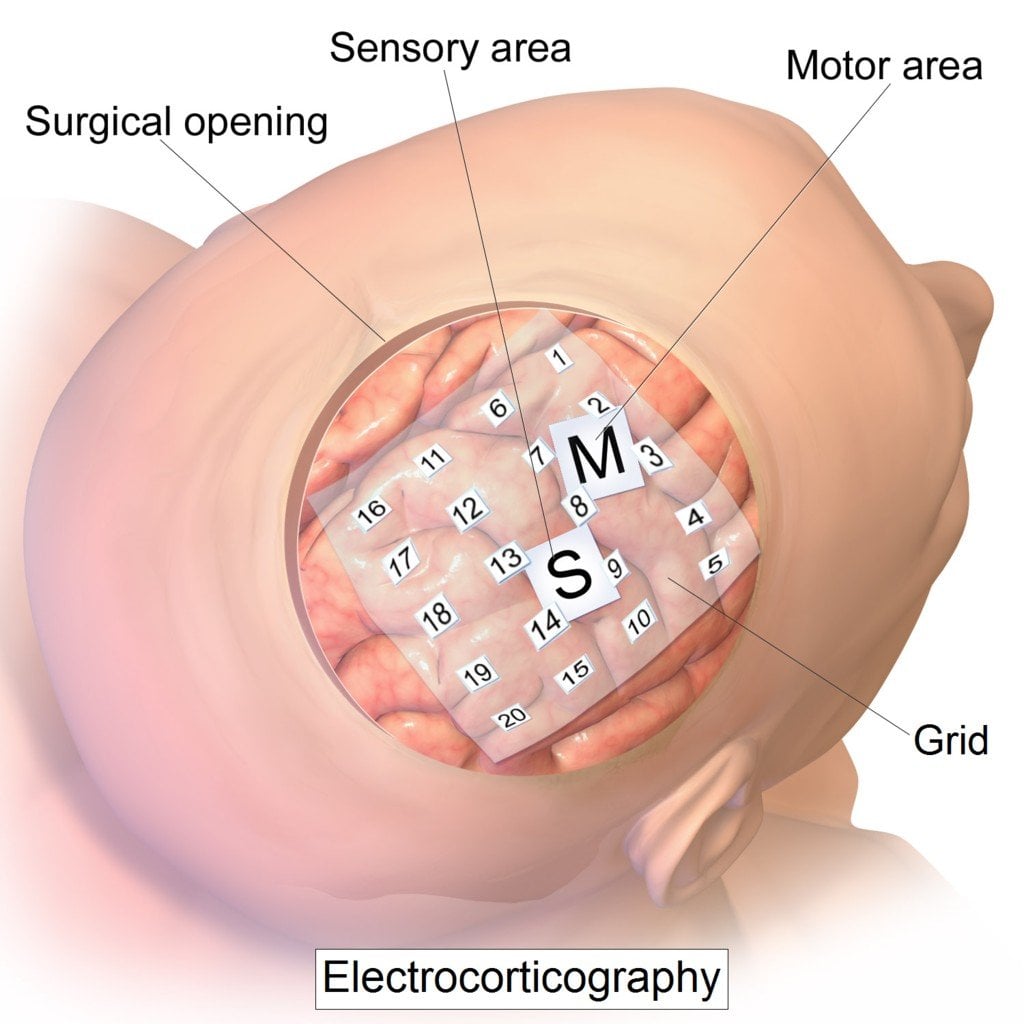 Intracranial electrode grid for electrocorticography