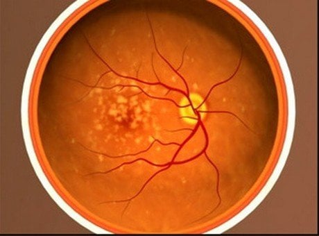 macular degeneration