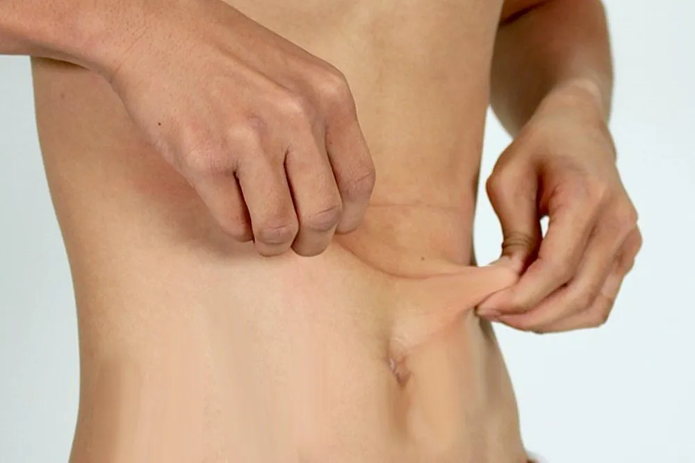 What Happens To The Excess Skin When You Lose A Lot Of Weight?