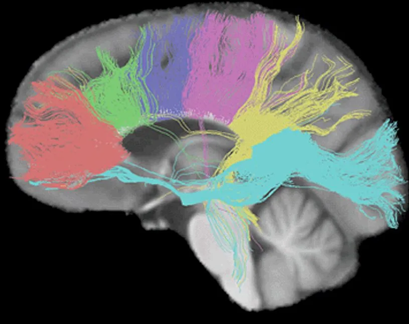 Corpus Callosum