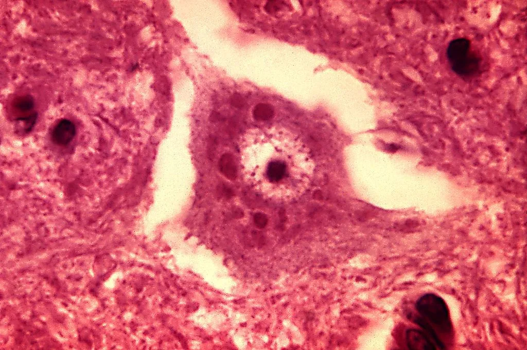 Rabies encephalitis Negri bodies PHIL 3377 lores