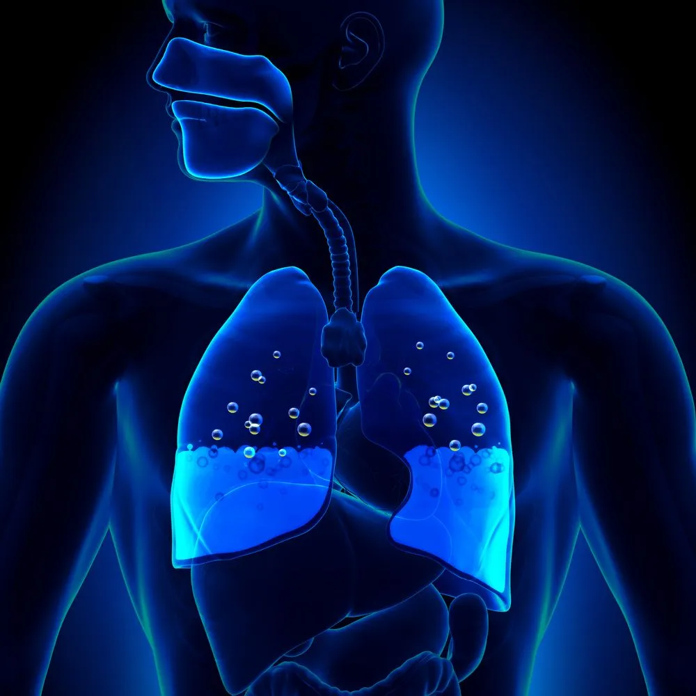 Pulmonary Edema - Water in Lungs Anatomy(decade3d - anatomy online)S