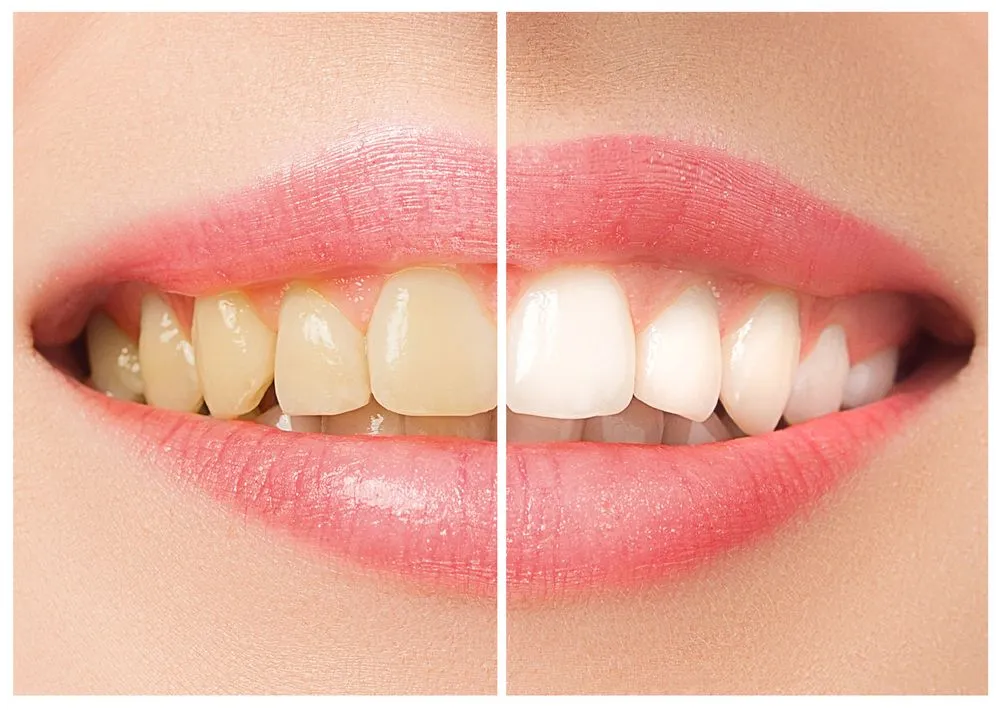 Teeth Bleaching: What Happens When You Bleach Your Teeth?
