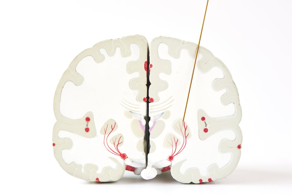 Microelectrode,Recording,Of,Globus,Pallidus,Interna,Or,Gpi,In,Parkinson;s