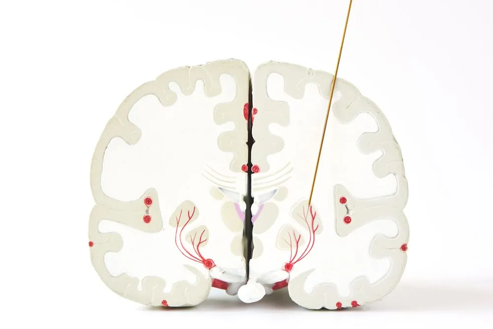 Microelectrode,Recording,Of,Globus,Pallidus,Interna,Or,Gpi,In,Parkinson;s