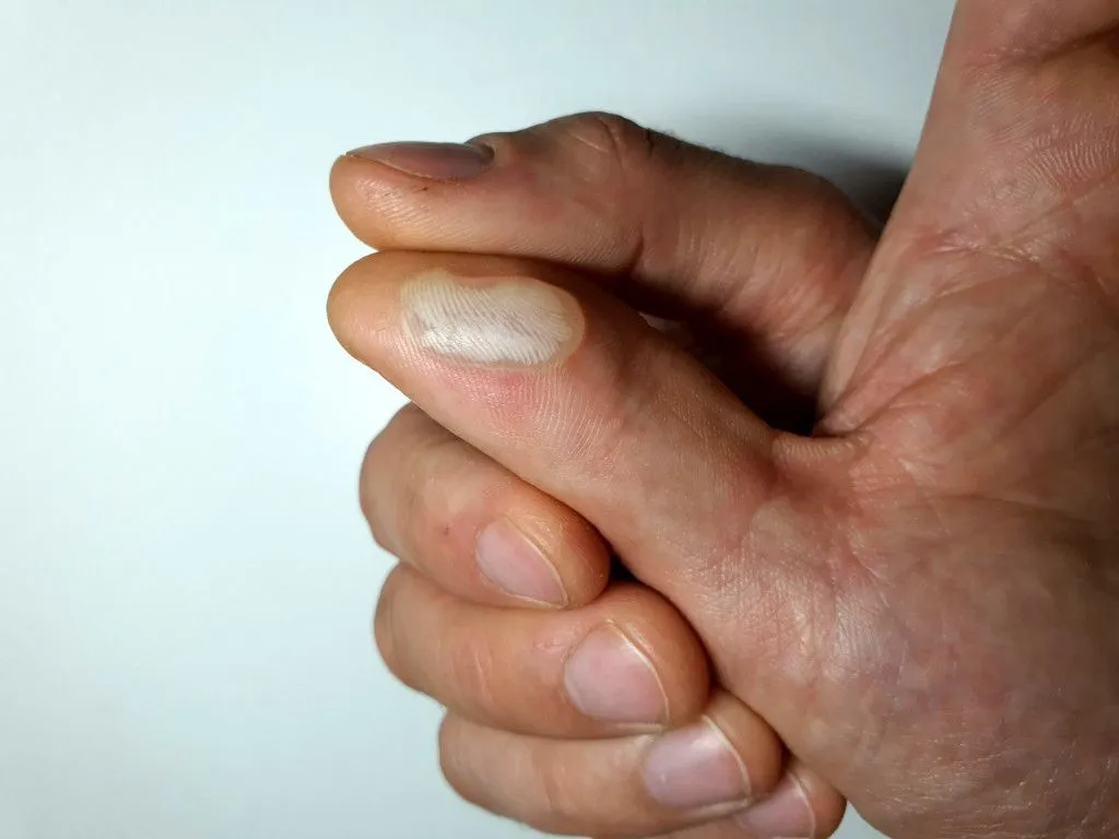 swollen-callus-on-the-hand-callus-bladder_t20_RJA8LQ
