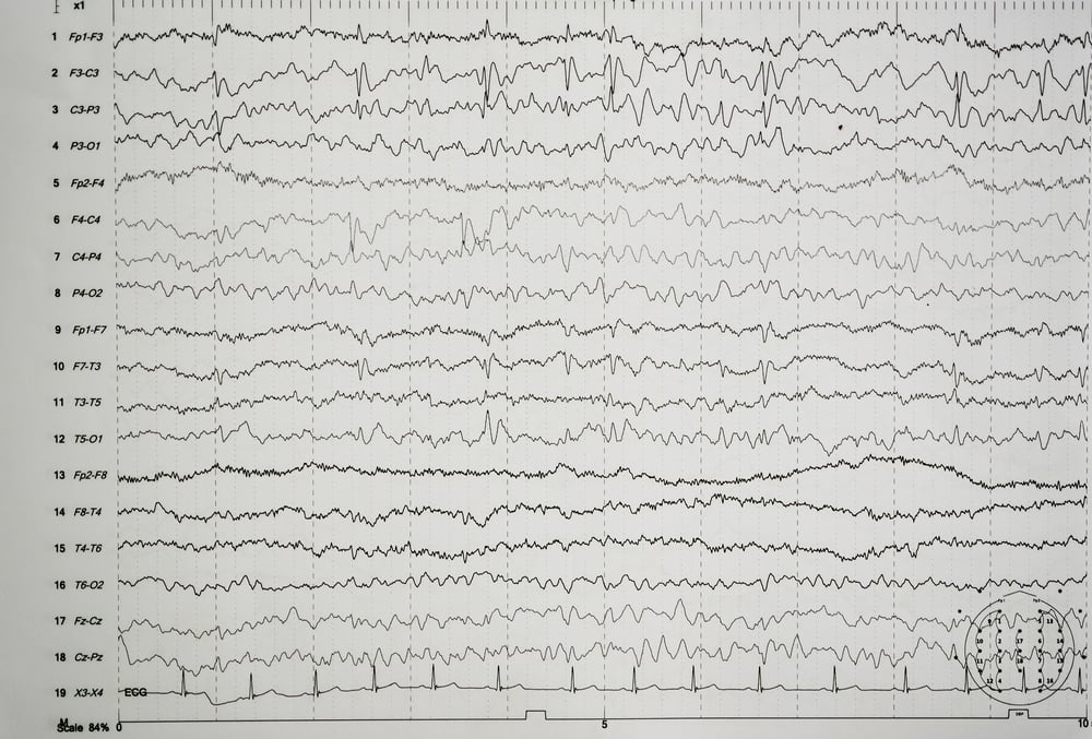 Eeg,Wave,In,Human,Brain,abnormal,Eeg,brain,Wave,On,Electroencephalogram,,eeg
