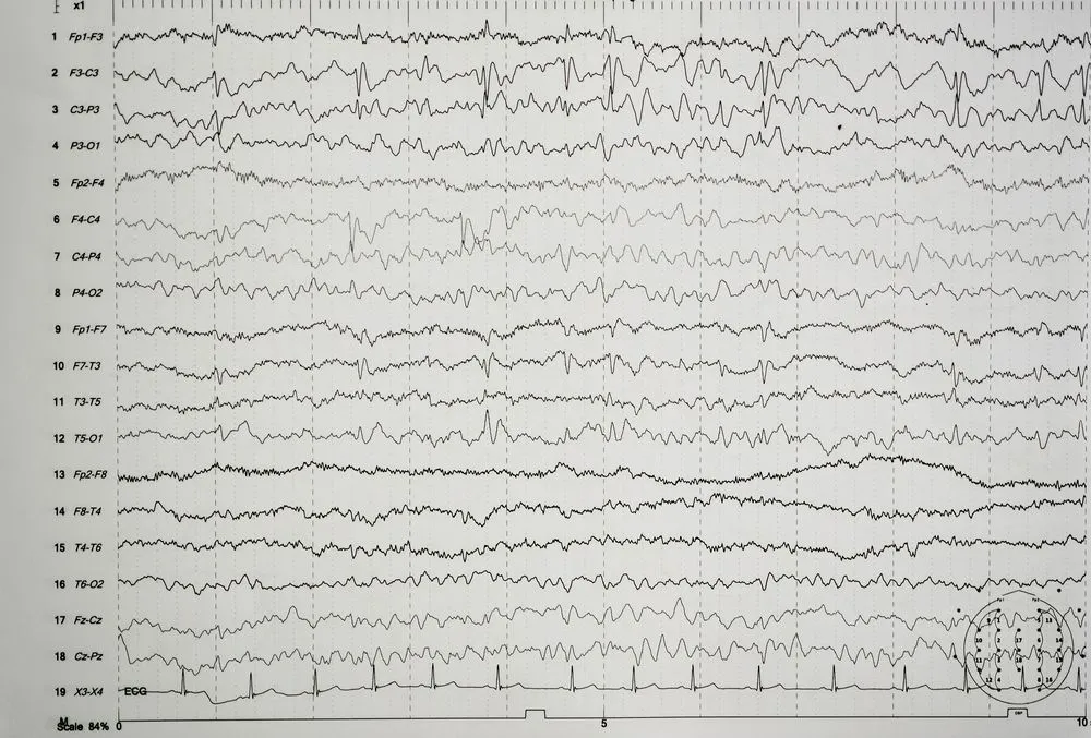 Eeg,Wave,In,Human,Brain,abnormal,Eeg,brain,Wave,On,Electroencephalogram,,eeg