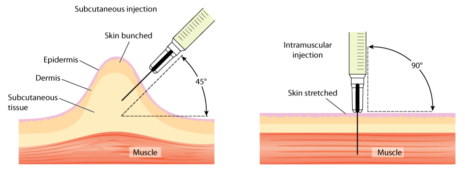 Different,Methods,For,Injecting,The,Skin,And,The,Muscle,,Showing
