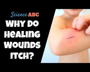 Why Do Healing Wounds Itch?