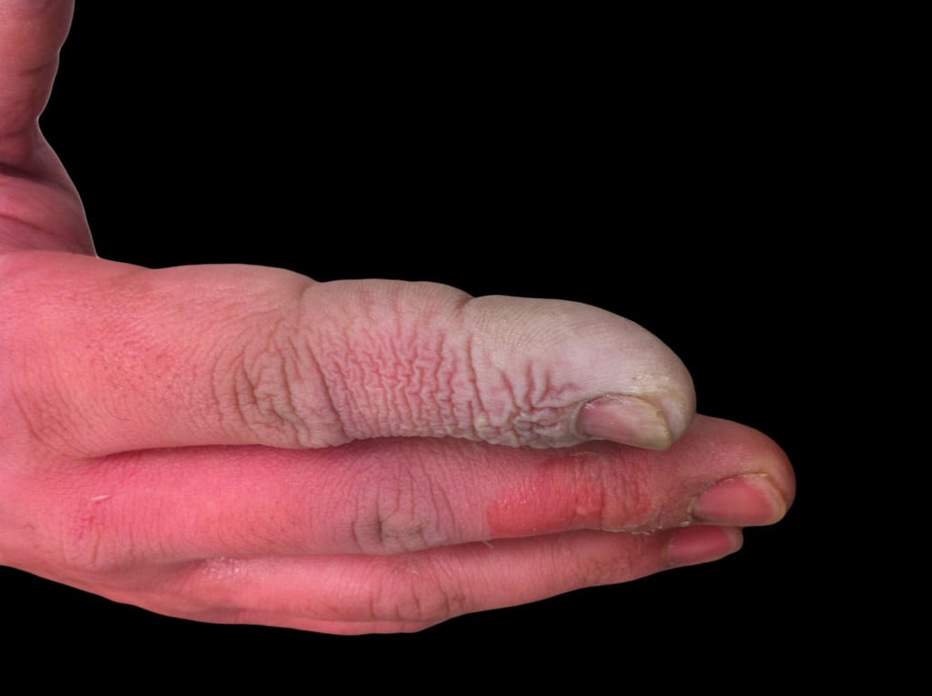 Even a weak concentration of Hydrofluoric acid is enough to cause burns on the skin