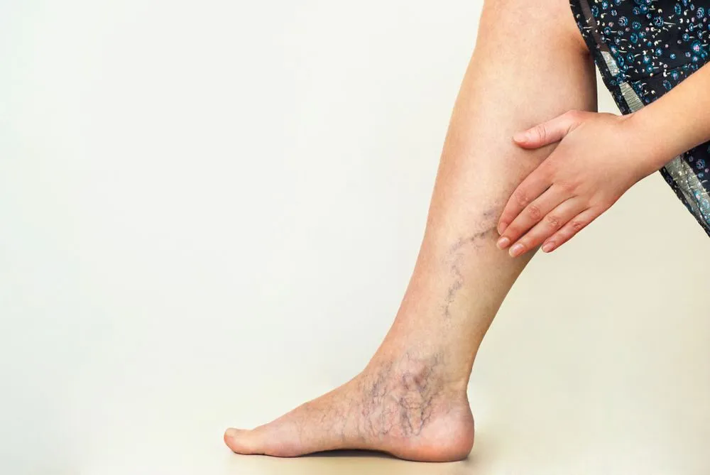 Varicose,Veins,On,The,Womans,Legs