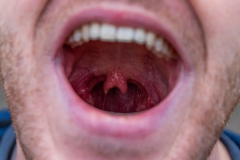 Some individuals have a two-lobed uvula. This usually isn’t detrimental, but doctors do remove one lobe when they detect this abnormality during infancy.(Credit: sunakri/Shutterstock)