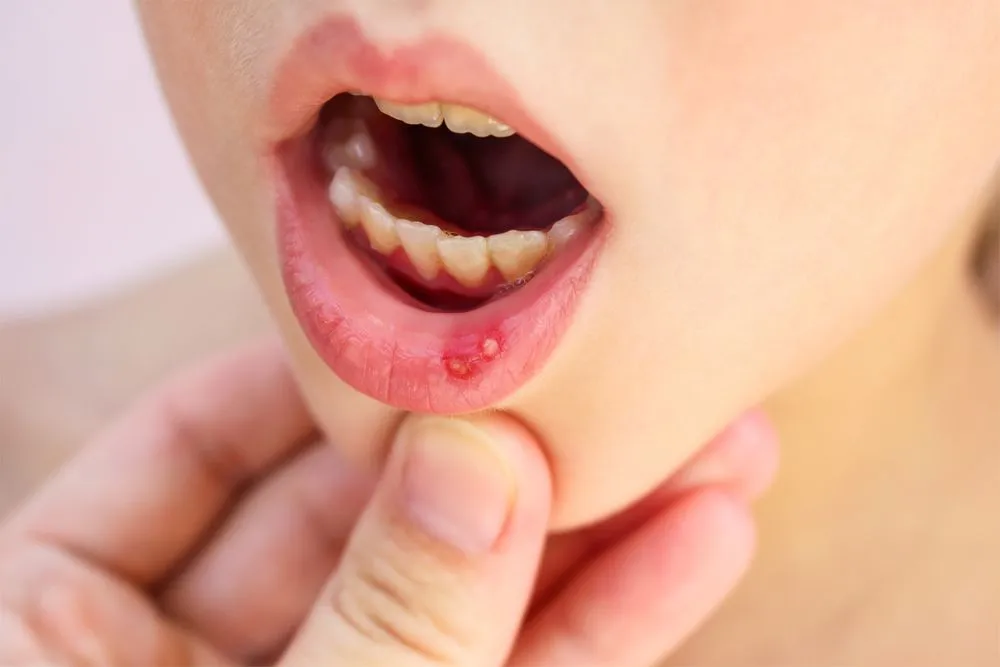 Wounds in the mouth heal faster than wounds on the skin (Credits: Victoria 1/Shutterstock)