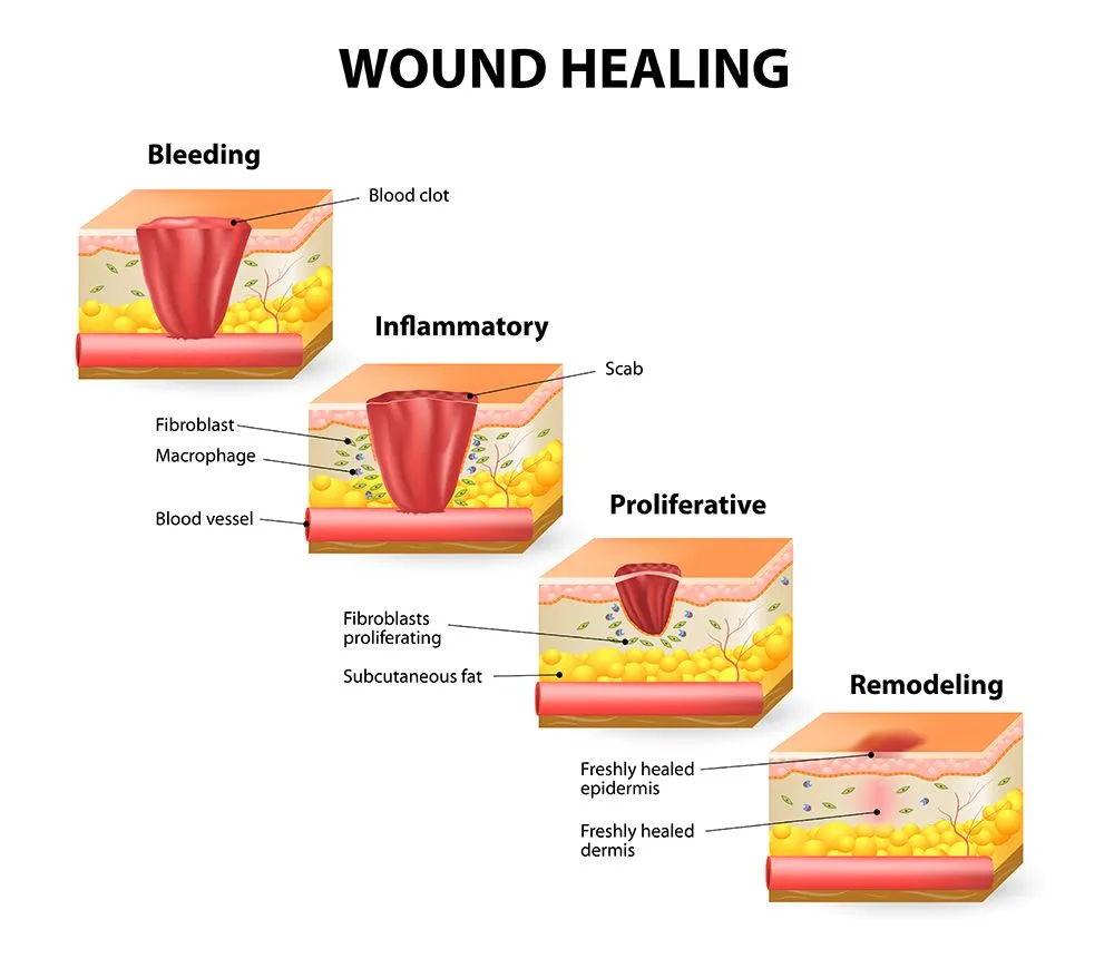 The wound healing process (Credits: Designua/Shutterstock)