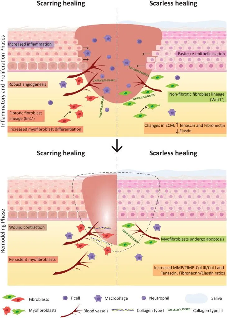 Several factors determine whether wound healing will proceed with or without scar formation (Credits: Pereira, D., & Sequeira, I. (2021, July 26). A Scarless Healing Tale: Comparing Homeostasis and Wound Healing of Oral Mucosa With Skin and Oesophagus. Frontiers in Cell and Developmental Biology. Frontiers Media SA. http://doi.org/10.3389/fcell.2021.682143 )