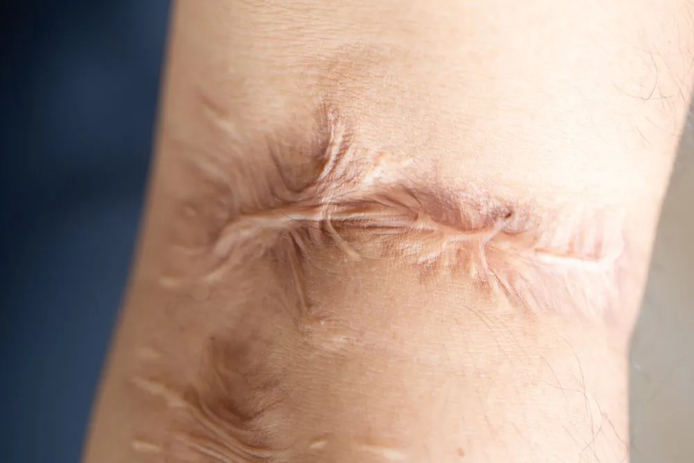 Scar tissue replaces normal skin after an injury (Credits: Rattiya Thongdumhyu/Shutterstock)