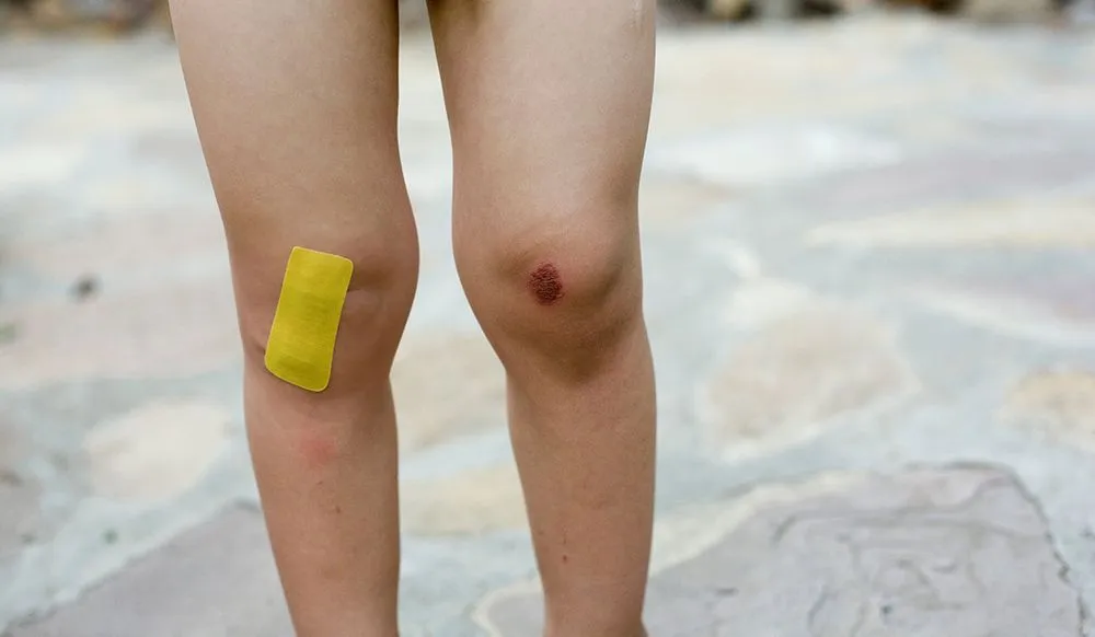 A woman with a scraped knee. (Credits: Image-Source/Envato Elements)