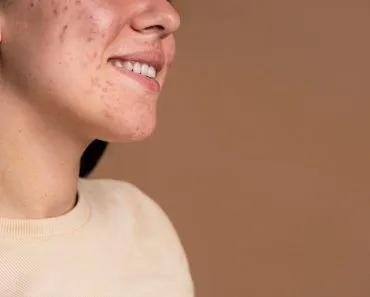 Can Your Acne Predict How Well You’ll Age?